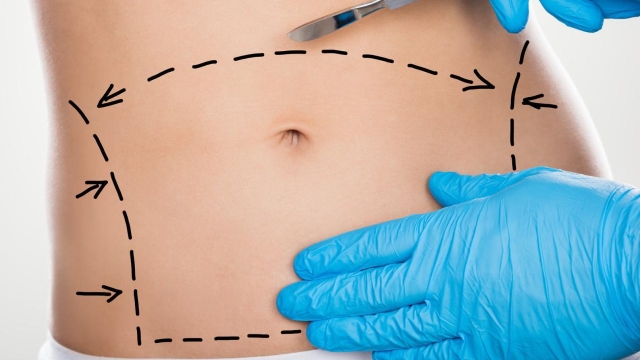 Flaunt your Flawless Figure: The Ultimate Guide to Abdominoplasty