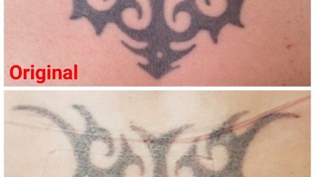 Laser Tattoo Removal Process